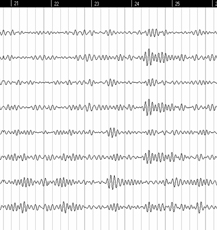 Neurobiologie und Flow - Eigene EEG-Studie zur Neurobiologie von Flow-Zuständen bei Musikern - Ergebnis 2: Ein Gehirn im gestressten Alltagsmodus